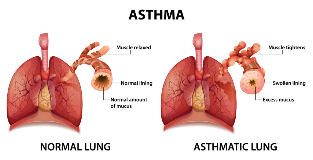 Comparison of healthy lung and Asthmatic lung illustration