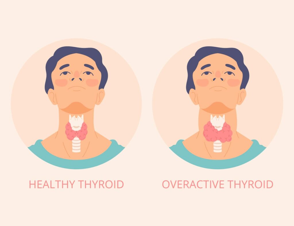 Thyroid diseases 1